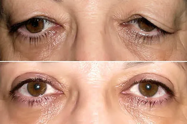 Blefaroplastia de pálpebras superiores