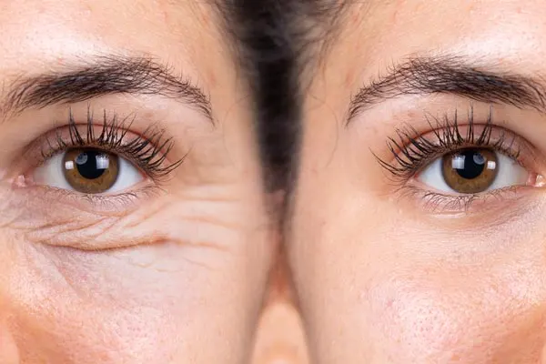 blefaroplastia para redução de bolsas de gordura nos olhos